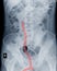 X-ray abdomen DJ stent in right ureter.medical image