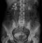 X-ray of the abdomen. Hydronephrosis right. Pyeloectasia left. Negative.