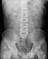 X-ray abdomen showing DJ stent in right ureter.medical image