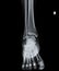 X Ray of Ankle joint front view.