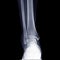 X-ray ankle joint or Radiographic image or x-ray image of right ankle joint