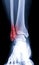 X-ray ankle or Radiographic image or x-ray image of right ankle joint front view for diagnosis of frature fibula bone