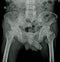 X-ray both Hip impression: Multiple bone metastasis