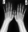 X-ray of both human hands.Normal human hands.