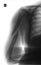 X-ray of the brachial bone. Helical humeral fracture. Negative.