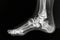 This x-ray captures a clear view of the bones within a foot, providing a detailed visualization of its structure, Ankle joint as