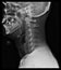 X-ray of the cervical spine