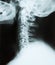 X-ray of a cervical spine(neck) of