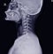 X-ray of the cervical spine showing Thoracic scoliosis with cervical spondylosis from C4-5 to C7-T1