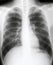 X-ray of chest of patient