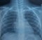An X-ray of the child's chest, a snapshot of the child's lungs. Respiratory diseases, pneumonia.