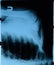 X-ray of  and clavicle, X ray picture of shoulder joint