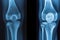 X ray CT Scan Knee Joint with knee pain Generative AI