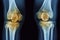 X ray CT Scan Knee Joint with knee pain Generative AI
