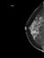 X-ray Digital Mammogram or mammography of both side breast showing benign tumor BI-RADS 2 should be checked once a year