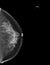 X-ray Digital Mammogram or mammography of both side breast showing benign tumor BI-RADS 2 should be checked once a year