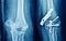 X-ray elbow bone fractureproximal ulnar or Olecranon fracture  and Post operation fix screws from traffic accident.  Medical