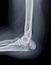 X-ray of Elbow join showing  fracture of ulna bone