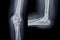 X-ray of Elbow join showing  fracture of ulna bone