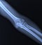 X-ray of the elbow joint.