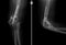 X-ray of the elbow joint. False joint.