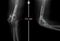 X-ray of the elbow joint. False joint. Marker.