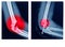 X-ray elbow showing  Supracondylar humerus fracture and post opretion fix K-wire