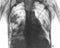 X-ray examination of patient with lung disease