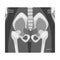 X-ray Film of Coxofemoral Joint Front View Vector Illustrated Image for Educational Purpose