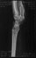 X-ray film of elbow joint