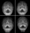 X-ray film of the face - frontal, nose-chin projection. Many of images. Sinusitis. norm.