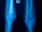 X ray film of knee