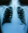 X-ray film, lung and bone structure, health examination