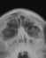 X-ray film of nasal bosoms of the child& x27;s skull