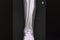 X-ray film of a patient with spiral fracture of right tibia