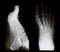 X-ray of a foot