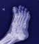 X-ray foot : 5th Metatarsal Base Fracture