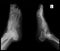 X-ray of the foot. Exostosis of the 5th metatarsal bone. Marker.