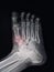 X-ray Foot Findings Fracture .