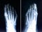 X-ray of foot fingers. Radiography with deformed toes. Hallux valg