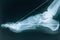 X-ray of the foot. Fracture of the bones of the foot. Bone fixation pins