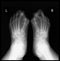 X-ray foot. Hallux valgus.