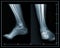 X-ray foot lateral and front view.