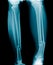 X-ray fracture leg