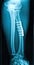 X-ray of fractured leg bone