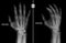 X-ray of the hand. Shows the subluxation of the proximal phalanx of the first finger of the right hand. Marker.