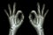 X-ray hands with OK sign