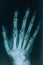 X-ray of the hands. Real x-ray picture of a hand with fingers. At the doctorâ€™s appointment, hospital.