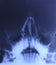X-ray of head: Sinusitis
