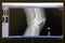 X-Ray of a healthy knee bone on a computer screen